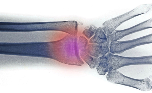 Upper Limb Fractures