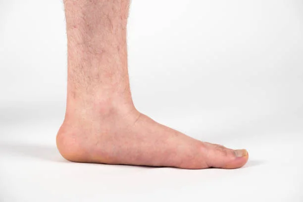 orthotics for flat feet