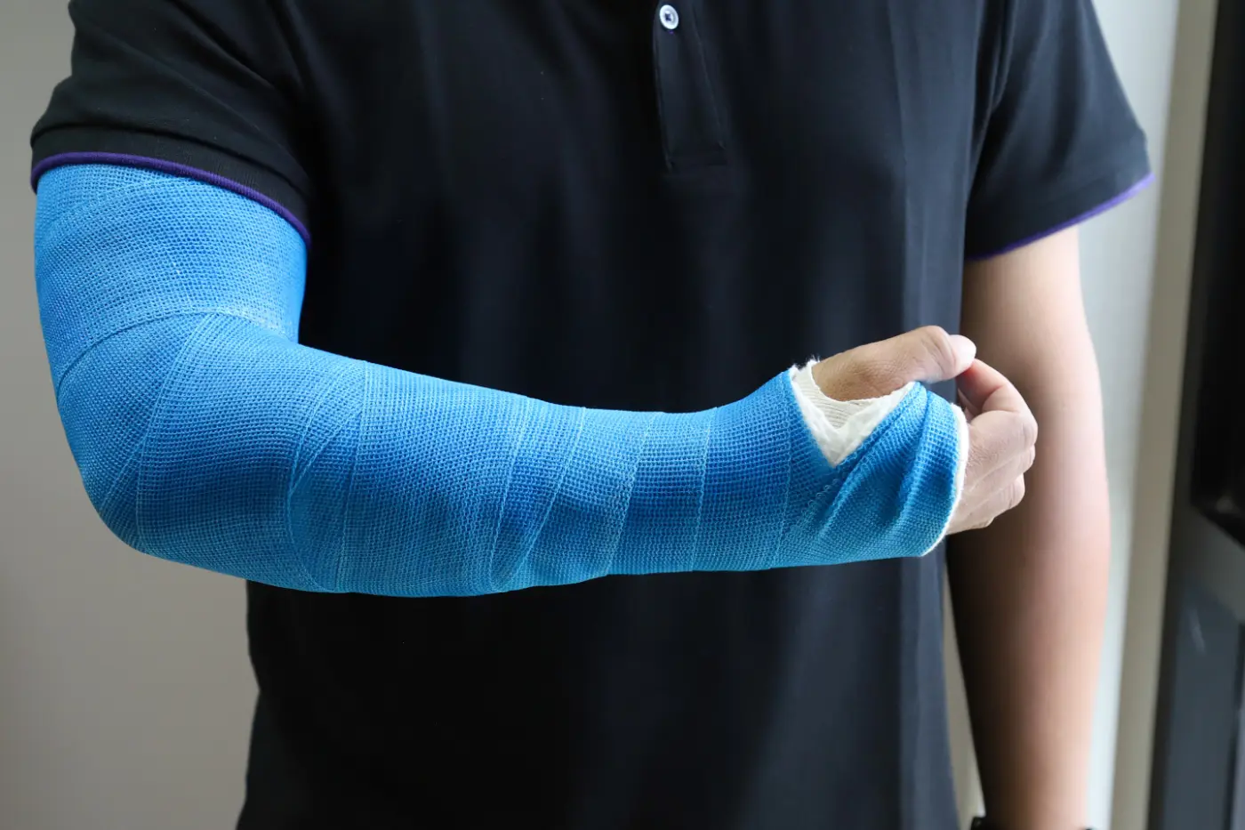 Closeup of Asian man's arm with long arm plaster